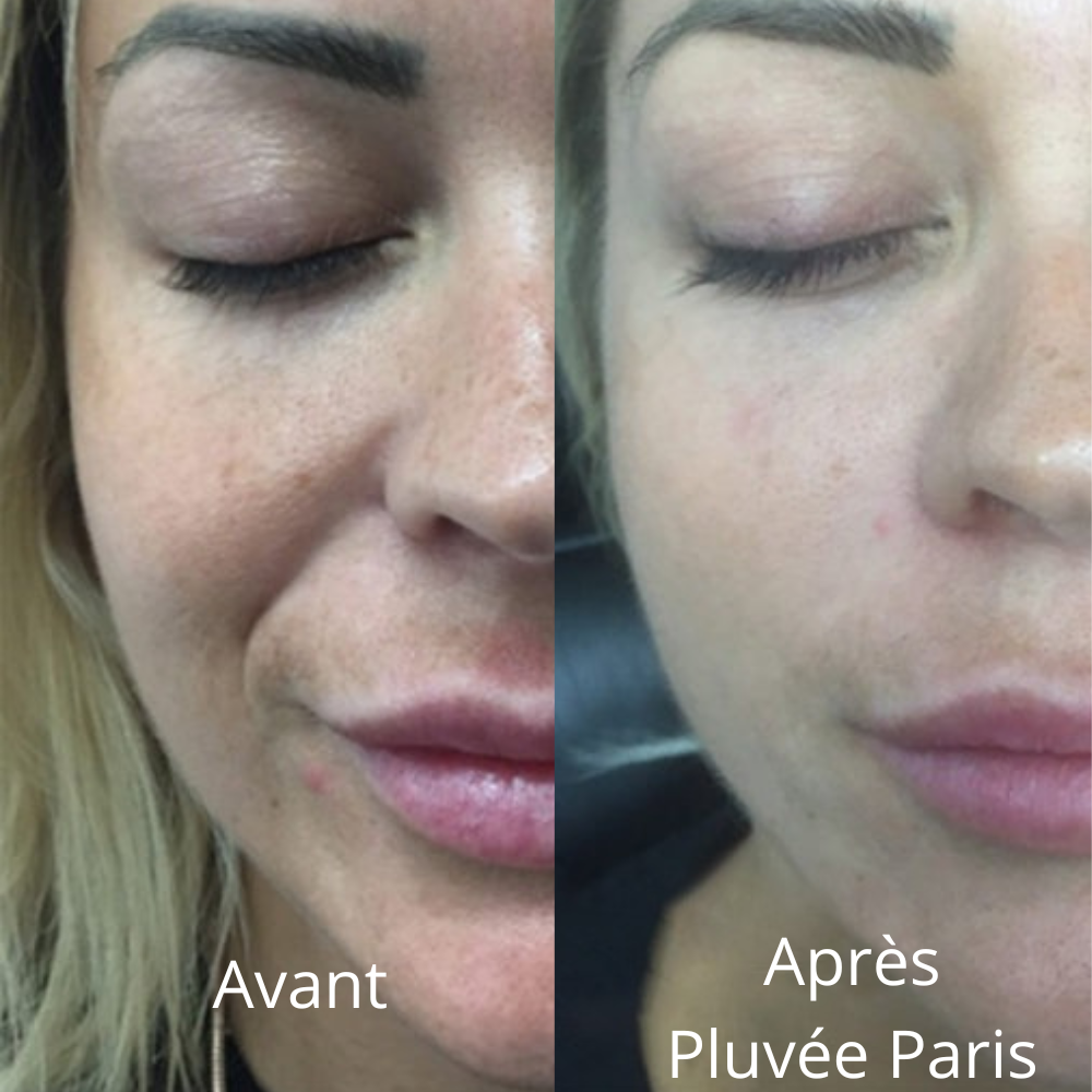 Micro-Infusion Kit Skin Boost+ | Pluvée Paris