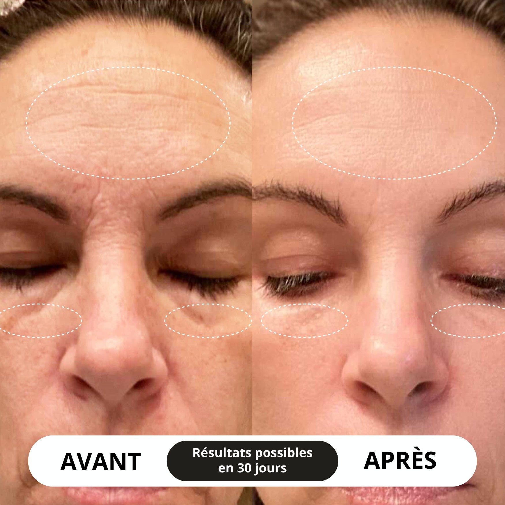 Résultat avant après d un soin lifting visage EMS montrant une réduction des rides et un teint plus uniforme